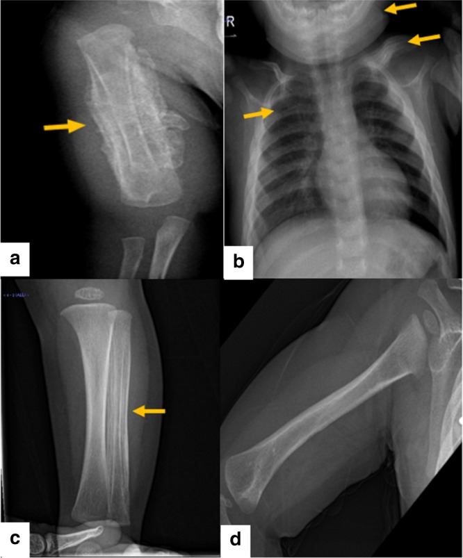 【佳学基因检测】德托尼-卡菲病基因解码、基因检测案例De Toni-Caffey disease 【佳学基因检测】德托尼-卡菲病基因解码、基因检测案例De Toni-Caffey disease