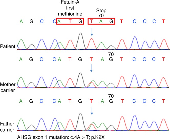 【佳学基因检测】德托尼-卡菲病基因解码、基因检测案例De Toni-Caffey disease 【佳学基因检测】德托尼-卡菲病基因解码、基因检测案例De Toni-Caffey disease