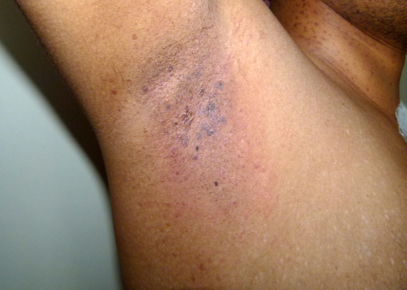 【佳学基因检测】黑点病基因检测（Dark dot disease）