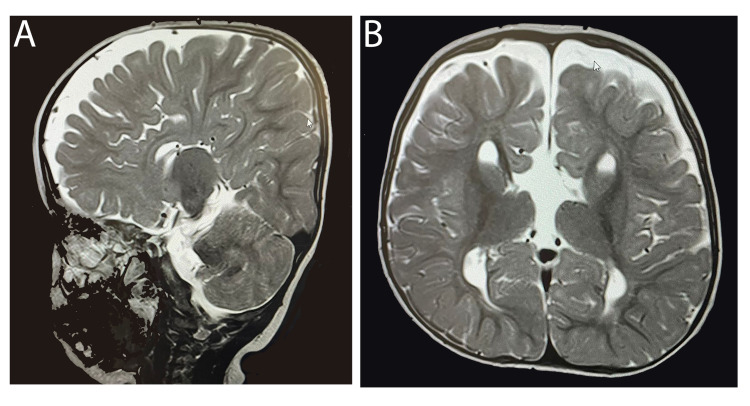 【佳学基因检测】唐奈-巴罗综合征基因检测（DBS)及其治疗