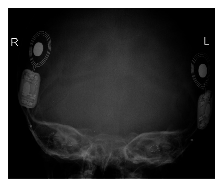 【佳学基因检测】唐奈-巴罗综合征基因检测（DBS)及其治疗