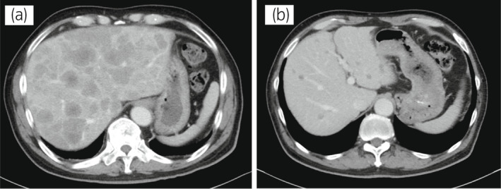 【佳学基因检测】靶向药物奥拉帕尼治疗具有BRCA突变的前列腺癌患者 【佳学基因检测】靶向药物奥拉帕尼治疗具有BRCA突变的前列腺癌患者