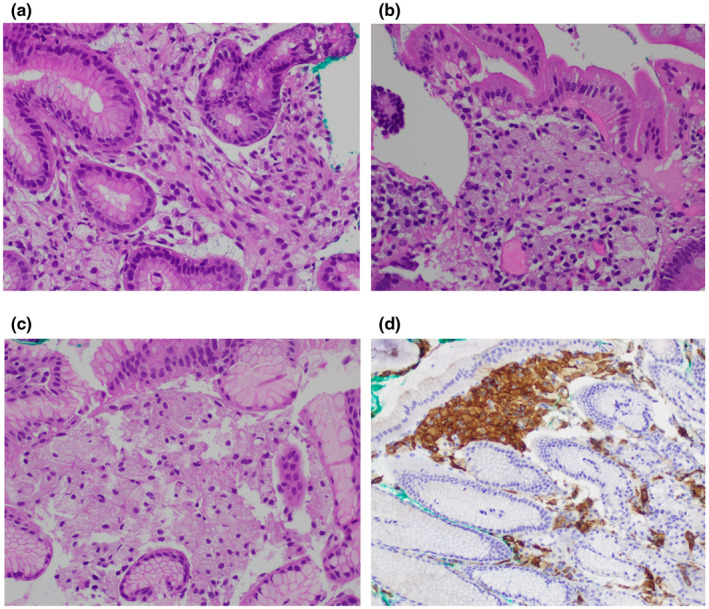 【佳学基因检测】CHILD综合征基因解码、基因检测有什么用? 【佳学基因检测】CHILD综合征基因解码、基因检测有什么用?