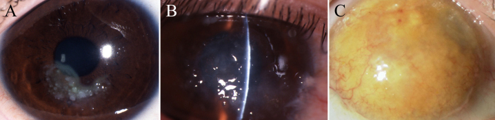 【佳学基因检测】怎样选择晶状体角膜营养不良Ⅲ型基因解码、基因检测? 【佳学基因检测】怎样选择晶状体角膜营养不良Ⅲ型基因解码、基因检测?